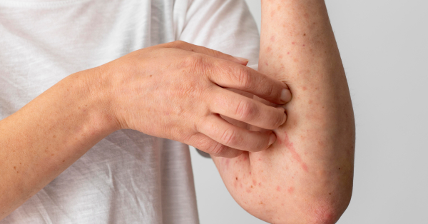 ruka čoveka koji se češe usled osipa od rubeola
